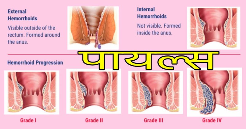 के हो पाइल्स ? कसरी बच्ने ?